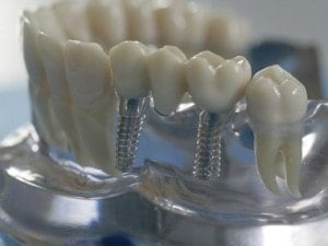 Modell eines Kieferknochens mit Zahnimplantaten (BILD: PRODENTE E.V.)
